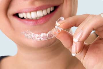 Invisalign, simple clear aligners to adjust teeth